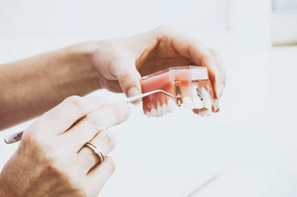 Dental implant faq