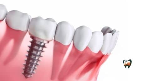 Lifespan Of Dental Implants