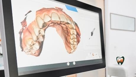 Types Of Dental Implants