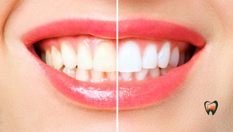 How To Improve Your Smile With Teeth Whitening