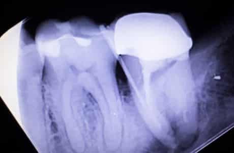 How Root Canals Work