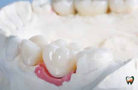 Cosmetic Dental Crown Benefits