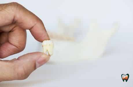 Tooth Extraction Appointment Tips