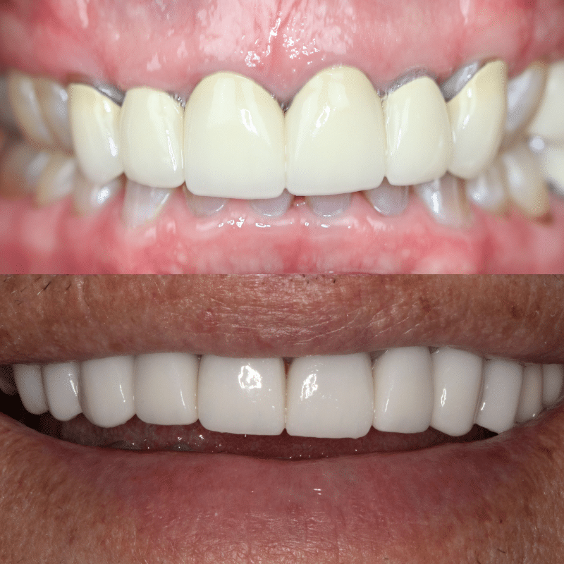 Smile Makeover Grand Junction CO